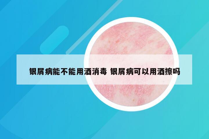 银屑病能不能用酒消毒 银屑病可以用酒擦吗