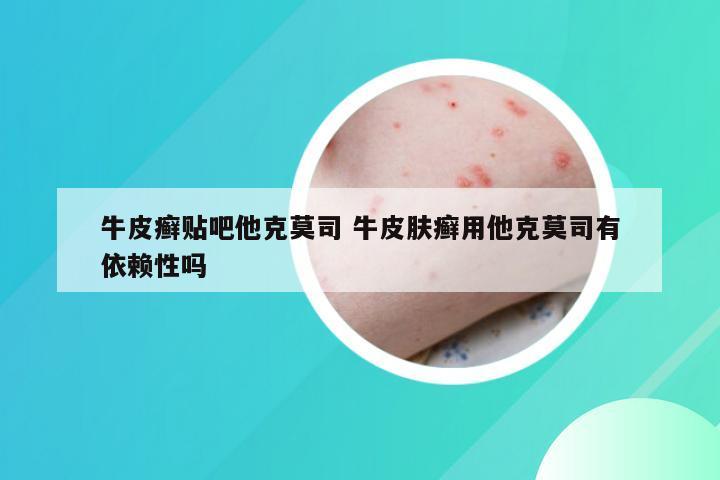 牛皮癣贴吧他克莫司 牛皮肤癣用他克莫司有依赖性吗