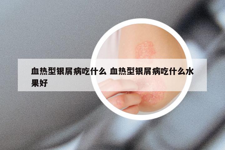 血热型银屑病吃什么 血热型银屑病吃什么水果好