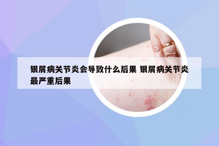 银屑病关节炎会导致什么后果 银屑病关节炎最严重后果