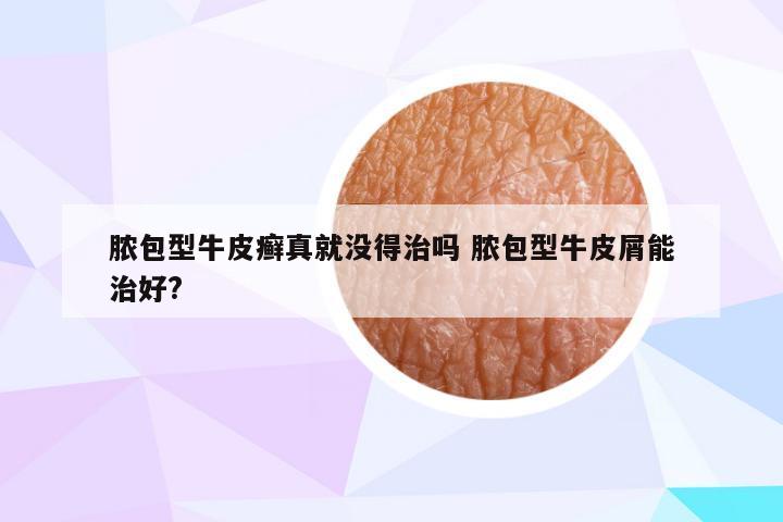 脓包型牛皮癣真就没得治吗 脓包型牛皮屑能治好?