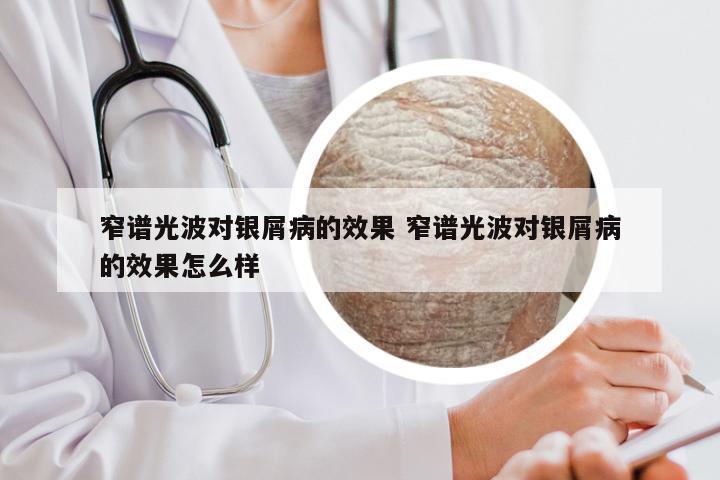 窄谱光波对银屑病的效果 窄谱光波对银屑病的效果怎么样