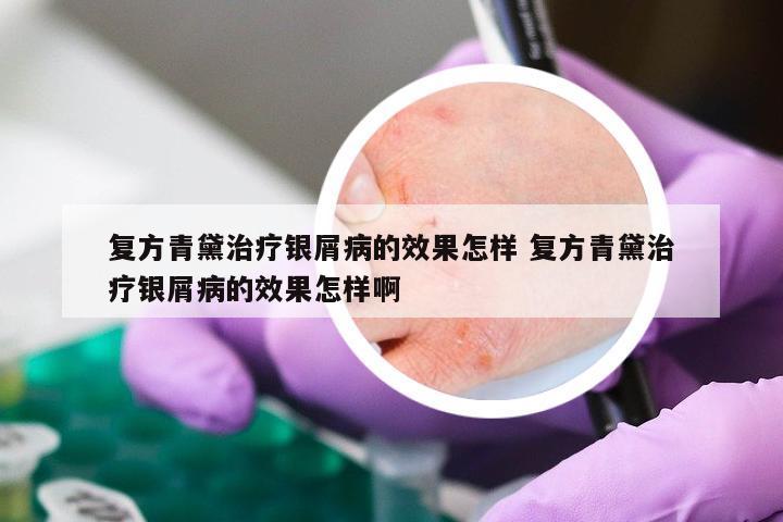 复方青黛治疗银屑病的效果怎样 复方青黛治疗银屑病的效果怎样啊