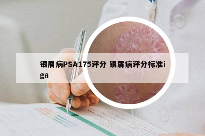 银屑病PSA175评分 银屑病评分标准iga