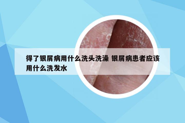 得了银屑病用什么洗头洗澡 银屑病患者应该用什么洗发水