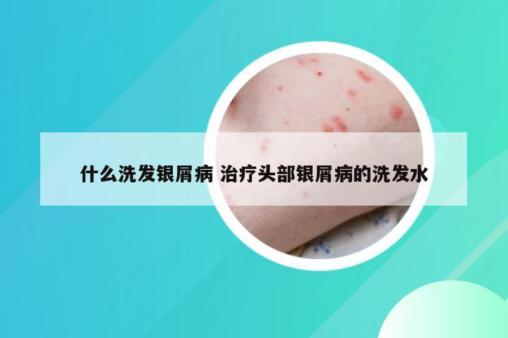 什么洗发银屑病 治疗头部银屑病的洗发水