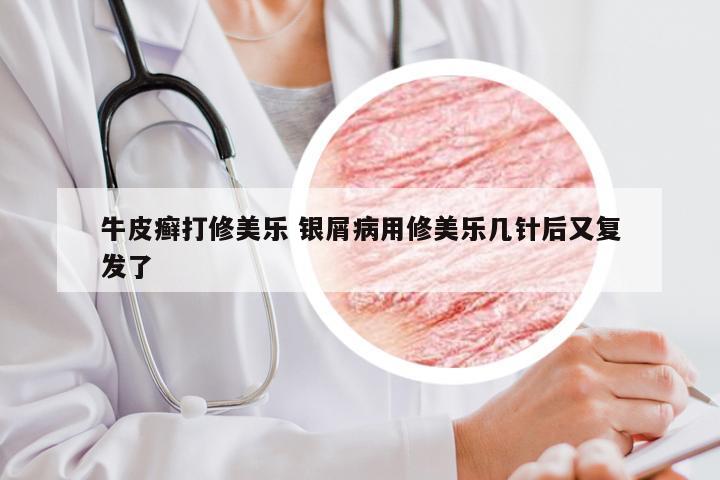 牛皮癣打修美乐 银屑病用修美乐几针后又复发了