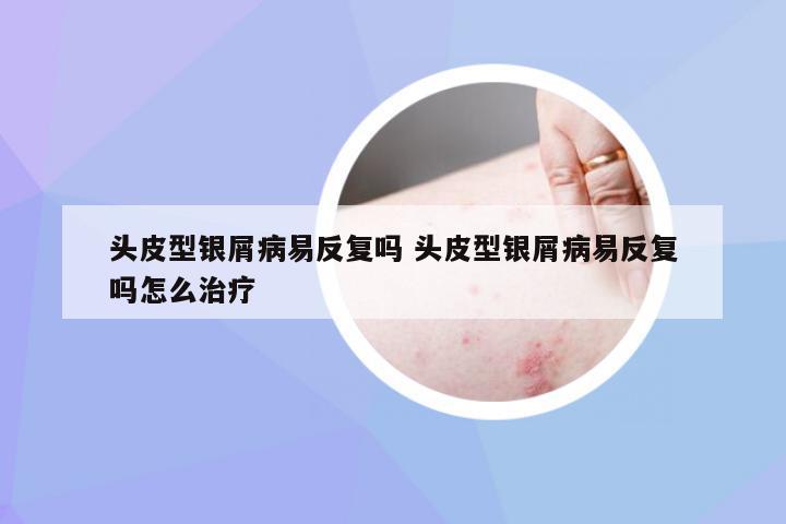 头皮型银屑病易反复吗 头皮型银屑病易反复吗怎么治疗