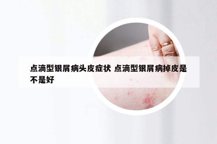 点滴型银屑病头皮症状 点滴型银屑病掉皮是不是好