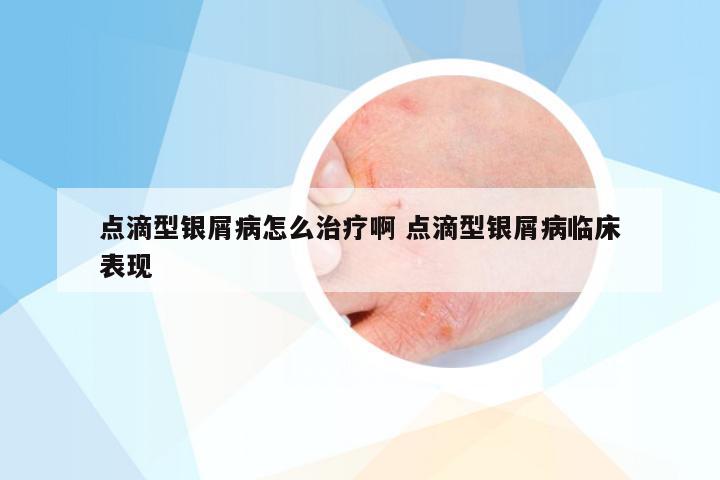 点滴型银屑病怎么治疗啊 点滴型银屑病临床表现