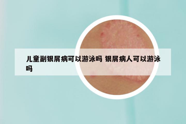 儿童副银屑病可以游泳吗 银屑病人可以游泳吗