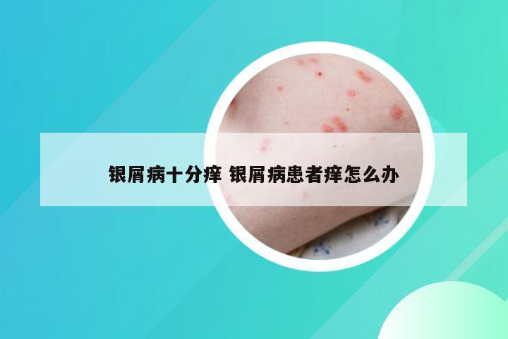 银屑病十分痒 银屑病患者痒怎么办