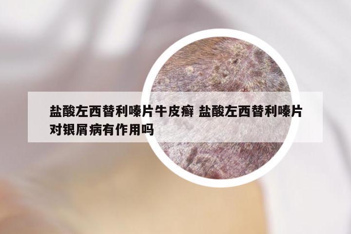 盐酸左西替利嗪片牛皮癣 盐酸左西替利嗪片对银屑病有作用吗