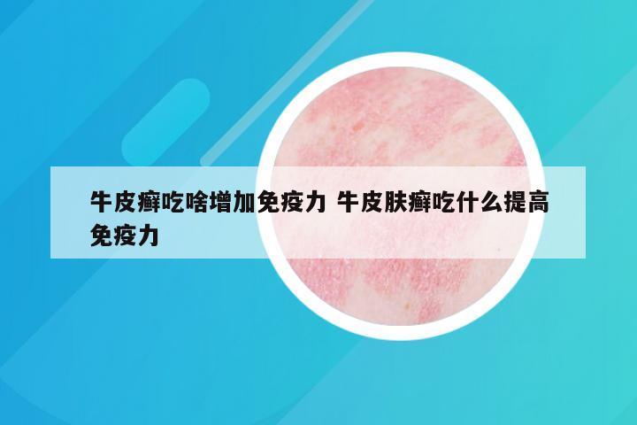 牛皮癣吃啥增加免疫力 牛皮肤癣吃什么提高免疫力