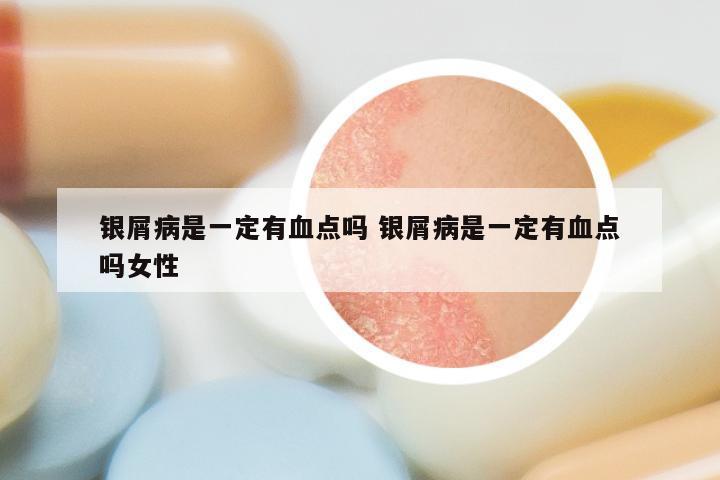 银屑病是一定有血点吗 银屑病是一定有血点吗女性