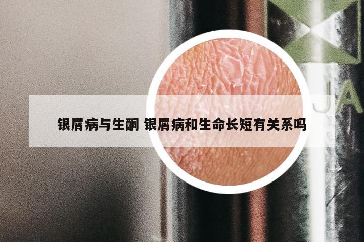 银屑病与生酮 银屑病和生命长短有关系吗