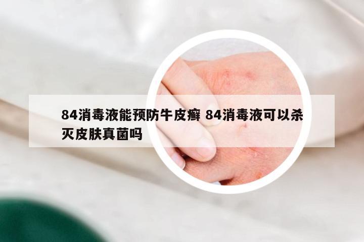 84消毒液能预防牛皮癣 84消毒液可以杀灭皮肤真菌吗