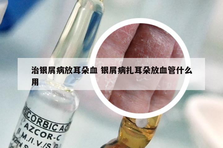 治银屑病放耳朵血 银屑病扎耳朵放血管什么用