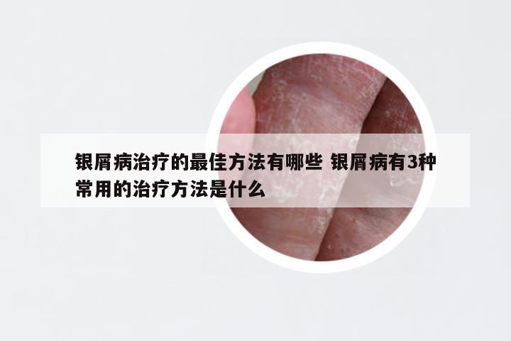 银屑病治疗的最佳方法有哪些 银屑病有3种常用的治疗方法是什么