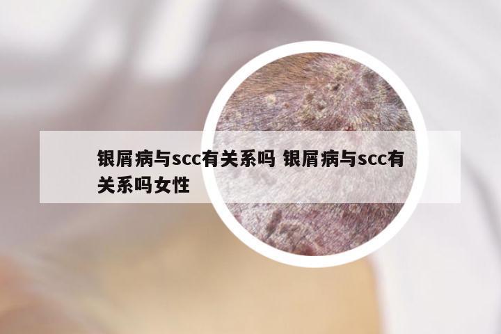 银屑病与scc有关系吗 银屑病与scc有关系吗女性