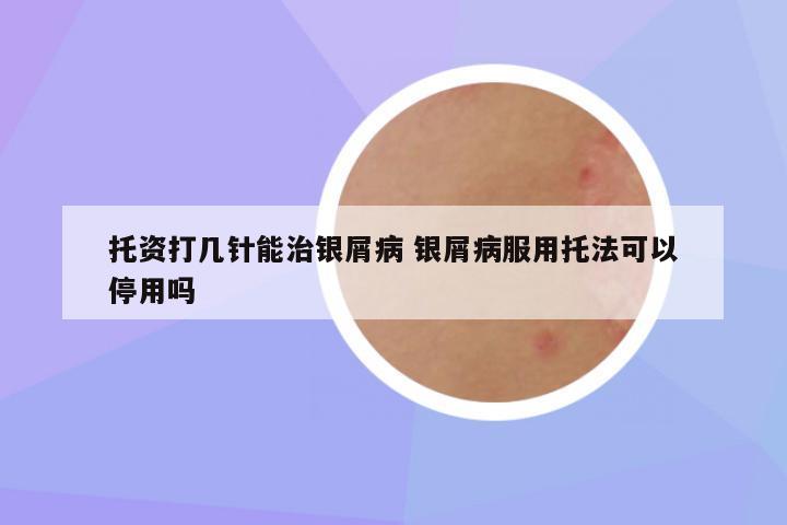 托资打几针能治银屑病 银屑病服用托法可以停用吗