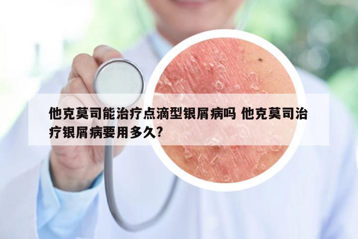 他克莫司能治疗点滴型银屑病吗 他克莫司治疗银屑病要用多久?