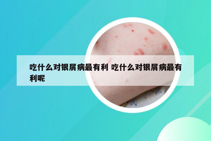 吃什么对银屑病最有利 吃什么对银屑病最有利呢