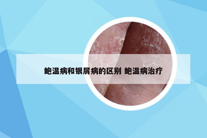 鲍温病和银屑病的区别 鲍温病治疗