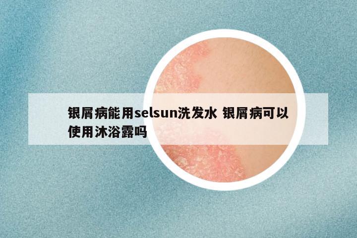 银屑病能用selsun洗发水 银屑病可以使用沐浴露吗