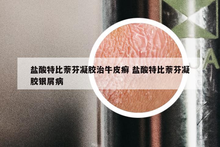 盐酸特比萘芬凝胶治牛皮癣 盐酸特比萘芬凝胶银屑病