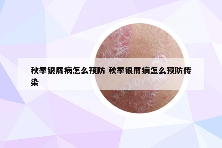 秋季银屑病怎么预防 秋季银屑病怎么预防传染