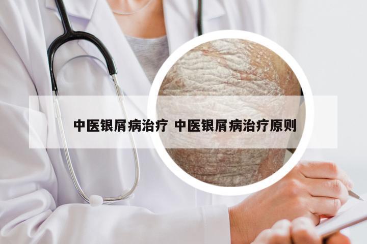 中医银屑病治疗 中医银屑病治疗原则