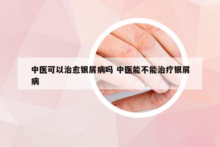 中医可以治愈银屑病吗 中医能不能治疗银屑病