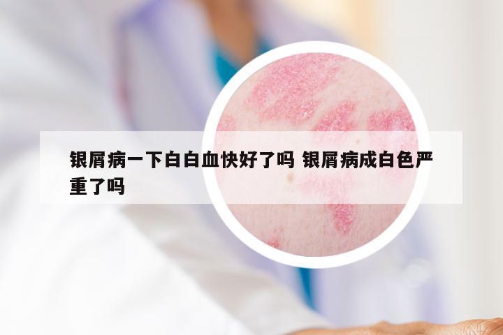 银屑病一下白白血快好了吗 银屑病成白色严重了吗