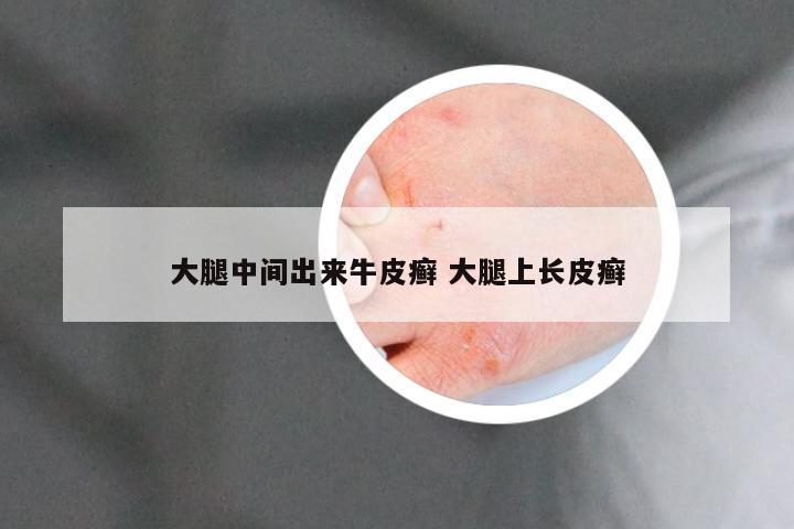 大腿中间出来牛皮癣 大腿上长皮癣