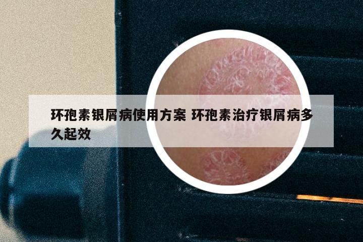 环孢素银屑病使用方案 环孢素治疗银屑病多久起效