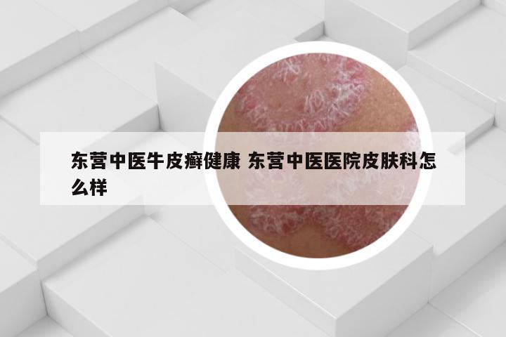 东营中医牛皮癣健康 东营中医医院皮肤科怎么样