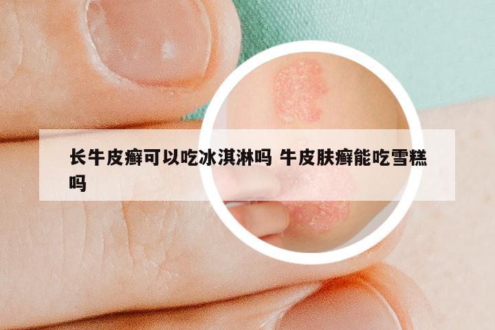 长牛皮癣可以吃冰淇淋吗 牛皮肤癣能吃雪糕吗