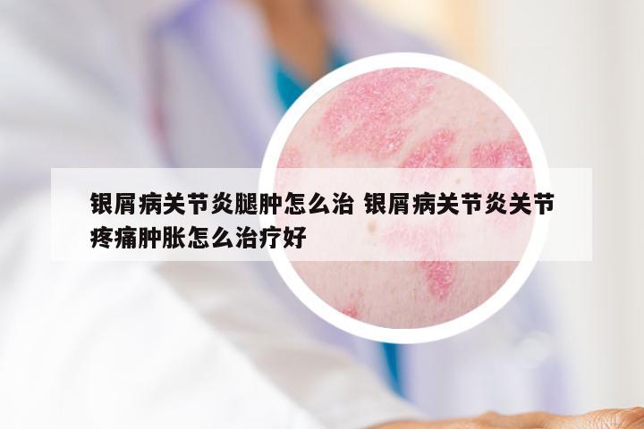 银屑病关节炎腿肿怎么治 银屑病关节炎关节疼痛肿胀怎么治疗好