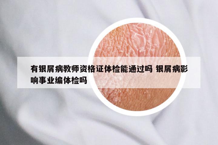 有银屑病教师资格证体检能通过吗 银屑病影响事业编体检吗