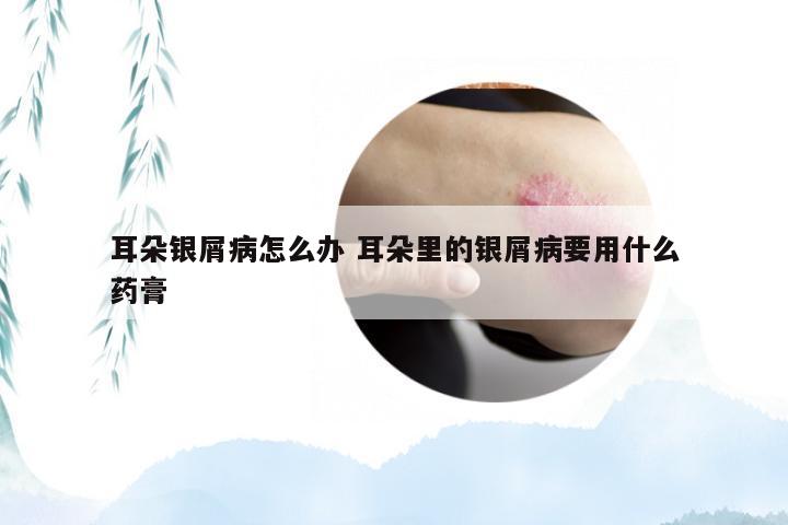 耳朵银屑病怎么办 耳朵里的银屑病要用什么药膏