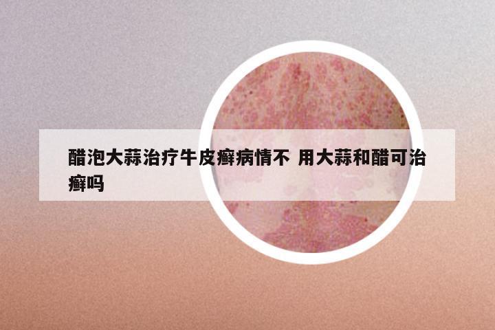 醋泡大蒜治疗牛皮癣病情不 用大蒜和醋可治癣吗