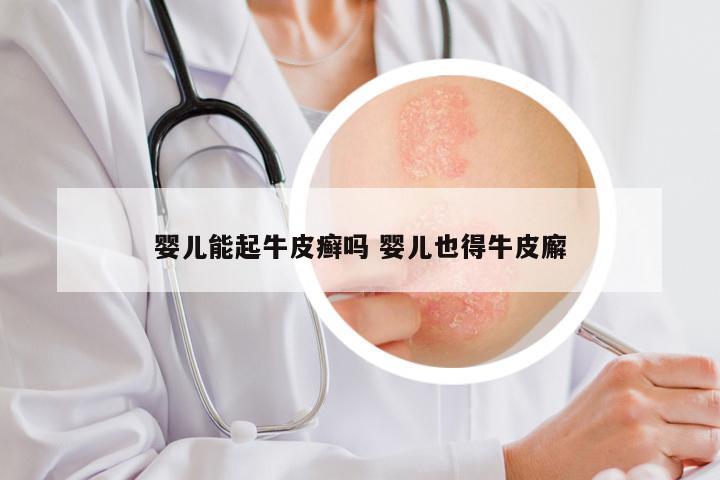 婴儿能起牛皮癣吗 婴儿也得牛皮廨