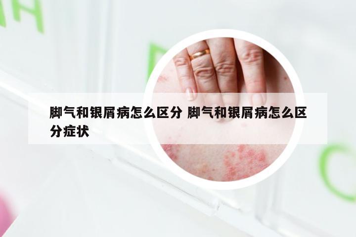 脚气和银屑病怎么区分 脚气和银屑病怎么区分症状