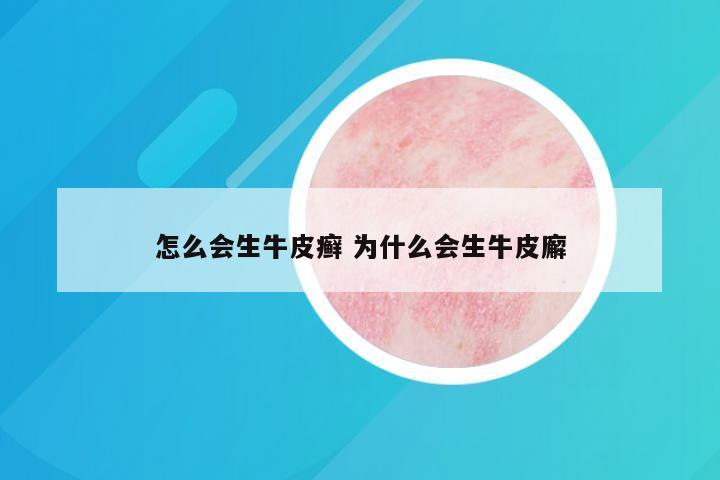 怎么会生牛皮癣 为什么会生牛皮廨