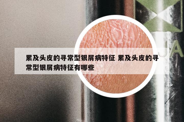 累及头皮的寻常型银屑病特征 累及头皮的寻常型银屑病特征有哪些