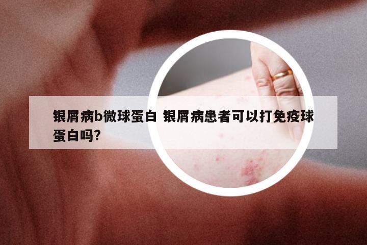 银屑病b微球蛋白 银屑病患者可以打免疫球蛋白吗?