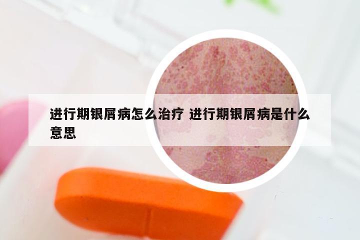 进行期银屑病怎么治疗 进行期银屑病是什么意思