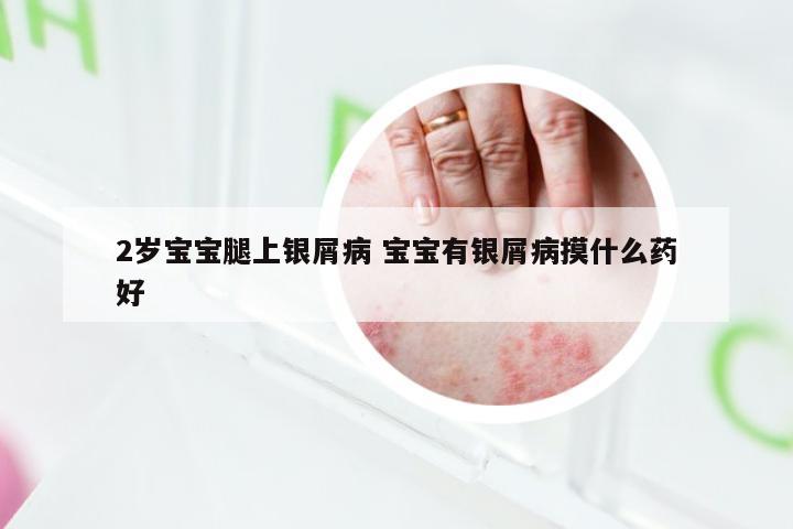 2岁宝宝腿上银屑病 宝宝有银屑病摸什么药好