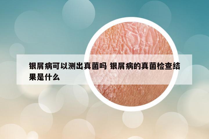 银屑病可以测出真菌吗 银屑病的真菌检查结果是什么